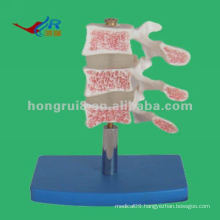 HR-134 Deluxe Human osteoporosis anatomical Model (3 vertebrae)